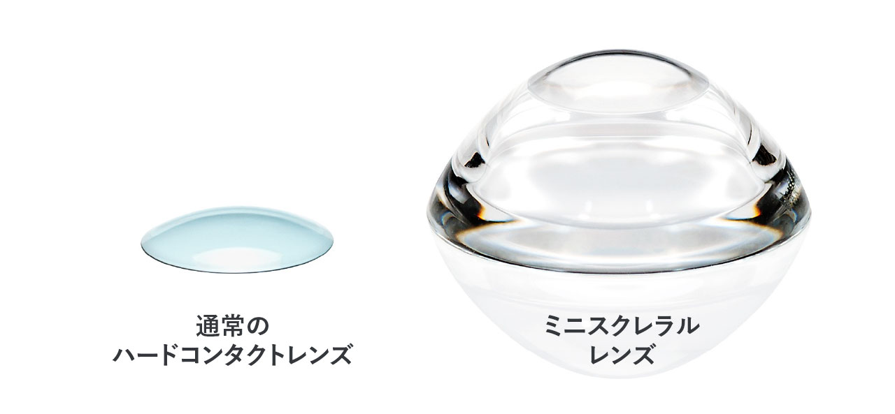 ハードコンタクトレンズ、強膜レンズの比較