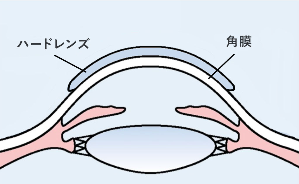 ハードコンタクトレンズ
